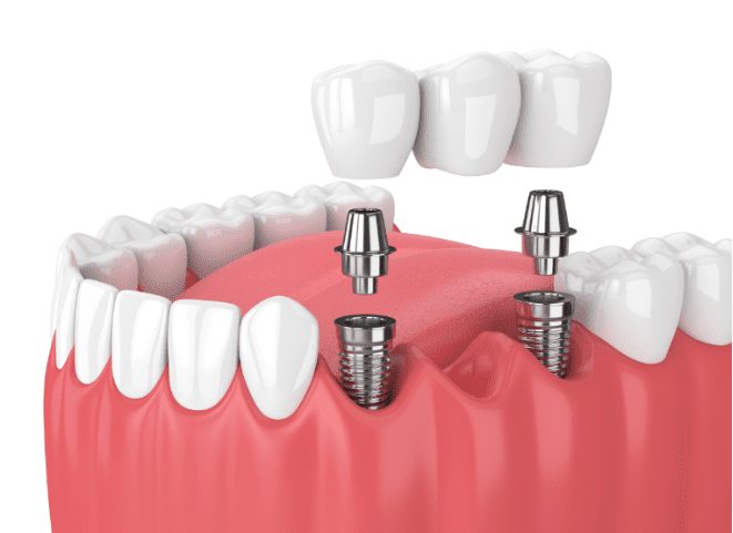 affordable implant-secured dental bridge in Charlotte, NC