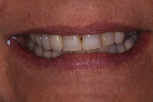 Before dentist treatment at Dentistry of The Queen City