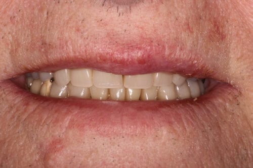 After dentist treatment at Dentistry of The Queen City