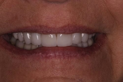 After dentist treatment at Dentistry of The Queen City