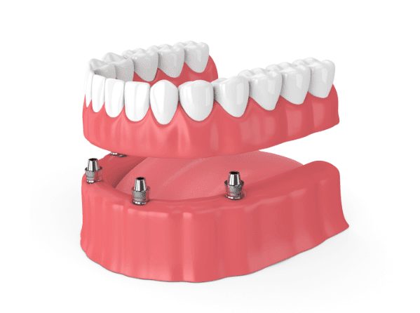 Affordable All-on-four Dentures in Charlotte North Carolina