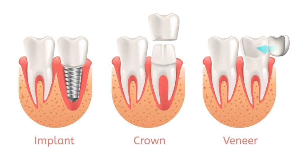 implants versus crowns versus veneers