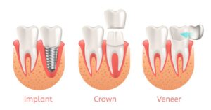 implants, crowns, and veneers in Charlotte, NC