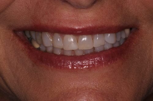 Before dentist treatment at Dentistry of The Queen City