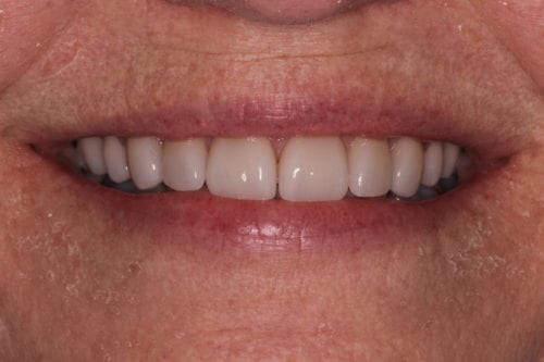 After dentist treatment at Dentistry of The Queen City
