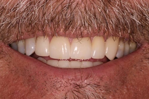 After dentist treatment at Dentistry of The Queen City