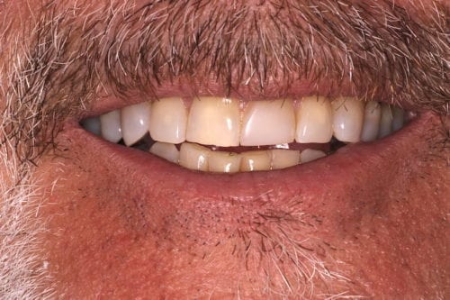 Before dentist treatment at Dentistry of The Queen City