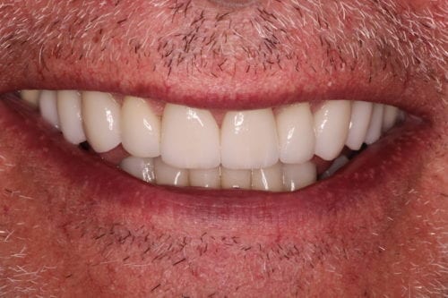 After dentist treatment at Dentistry of The Queen City