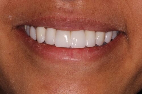 After dentist treatment at Dentistry of The Queen City