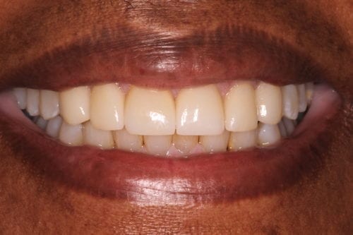 After dentist treatment at Dentistry of The Queen City