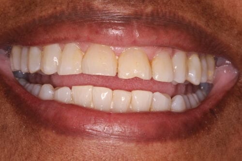 Before dentist treatment at Dentistry of The Queen City