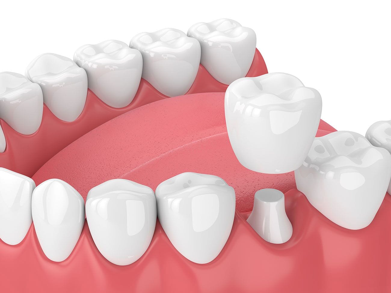 Dental Crowns in Charlotte & Concord, NC Dr. Greg Reece