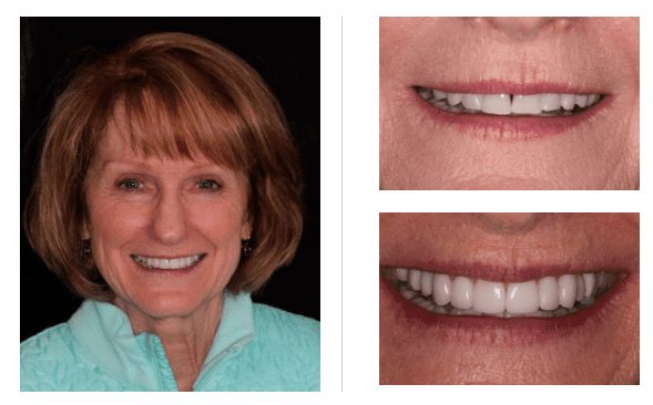 Before and after porcelain veneers in Charlotte, North Carolina