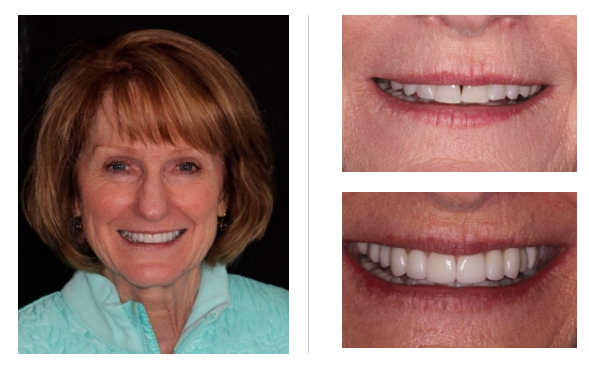 Porcelain Veneers In Charlotte Nc Concord Nc Dr Reece