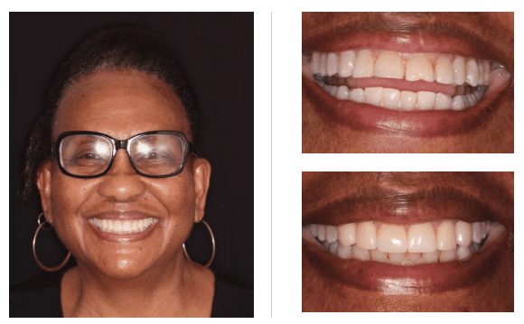 Before and after porcelain veneers in Charlotte, North Carolina