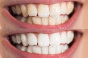 Teeth whitening in Concord