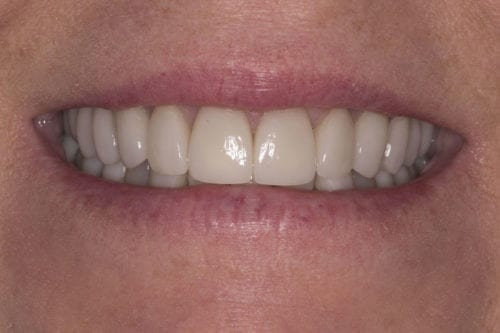 After dentist treatment at Dentistry of The Queen City