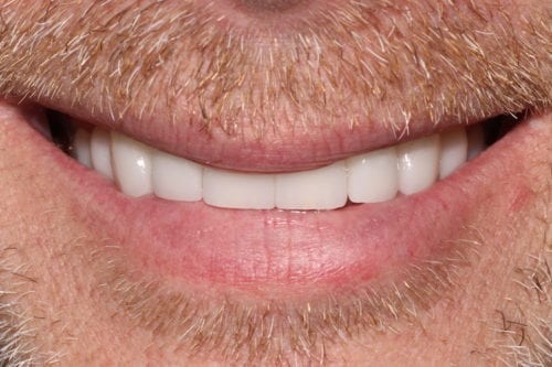 After dentist treatment at Dentistry of The Queen City