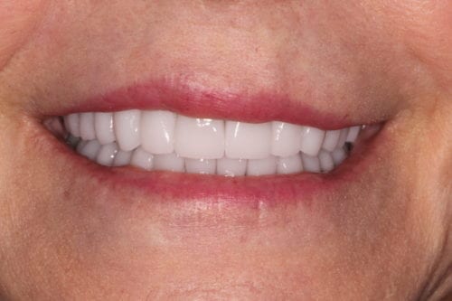 After dentist treatment at Dentistry of The Queen City