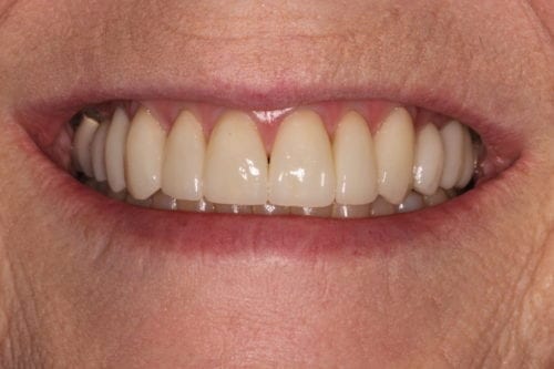 After dentist treatment at Dentistry of The Queen City
