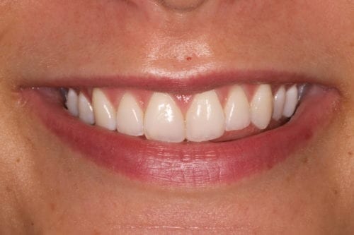 After dentist treatment at Dentistry of The Queen City