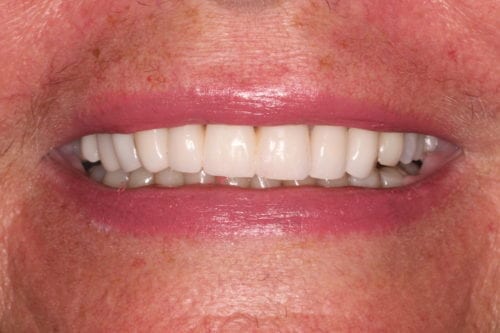 After dentist treatment at Dentistry of The Queen City