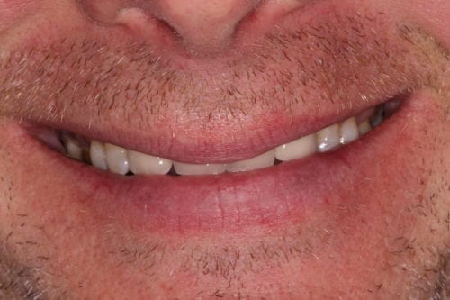 Before dentist treatment at Dentistry of The Queen City