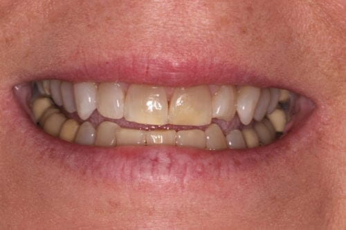 Before dentist treatment at Dentistry of The Queen City