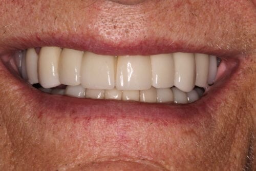 After dentist treatment at Dentistry of The Queen City