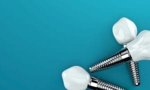 affordable dental implants in charlotte, north carolina