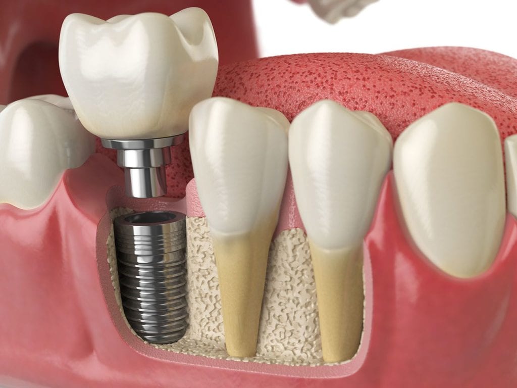 dental implants dentistry