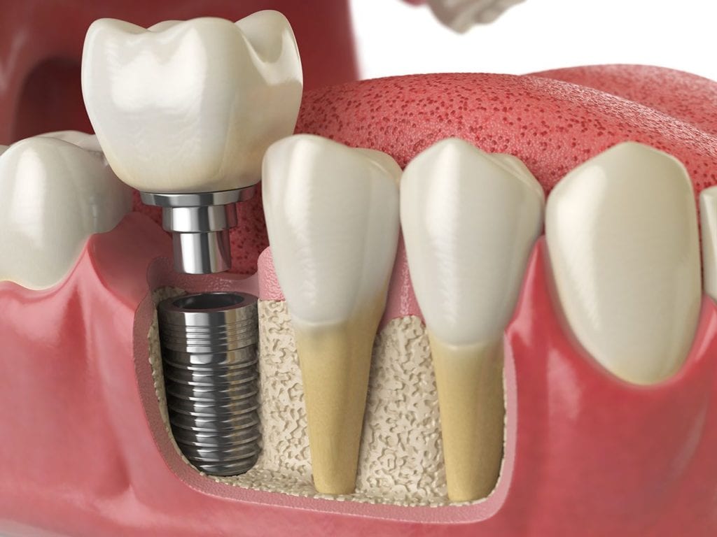 dental implants dentistry charlotte nc