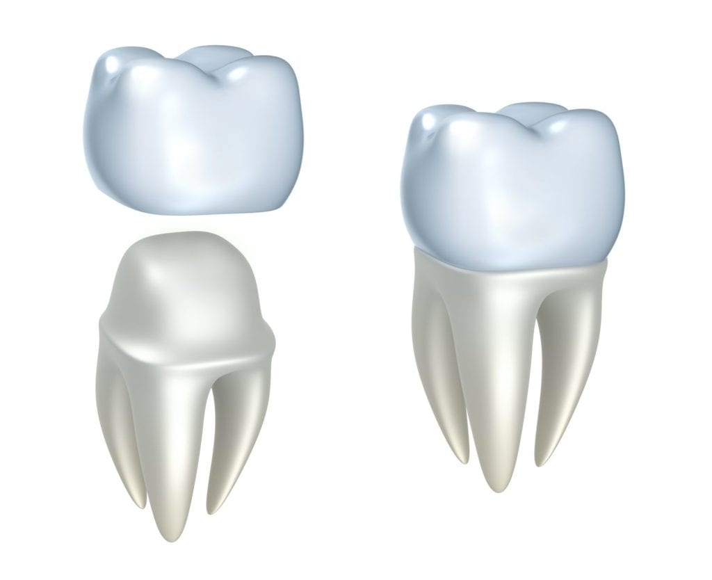 dental crown benefits in Charlotte North Carolina