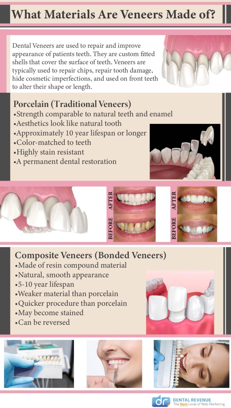 Types of Materials for Veneers Infographic