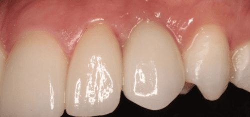 After dentist treatment at Dentistry of The Queen City