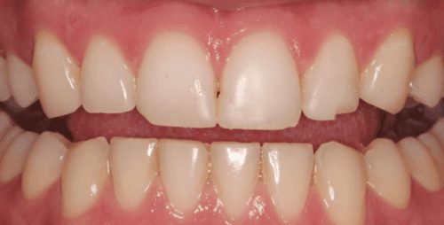 Before dentist treatment at Dentistry of The Queen City