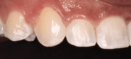 After dentist treatment at Dentistry of The Queen City