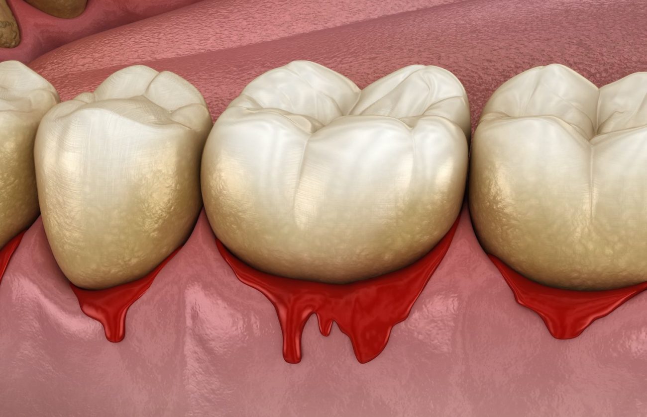 bleeding gums treatment in Charlotte North Carolina