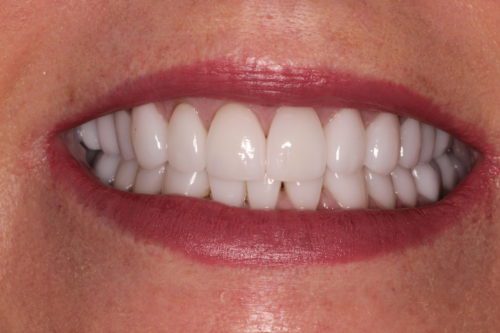 After dentist treatment at Dentistry of The Queen City