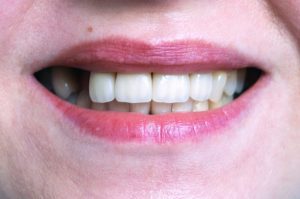 preventing missing teeth Charlotte North Carolina