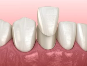 porcelain veneers cosmetic dental procedure