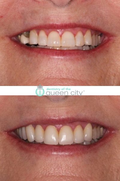 Before and after dental services at Dentistry of the Queen City