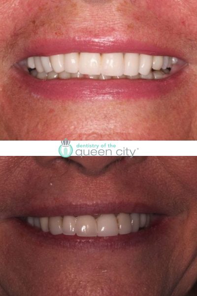Before and after dental services at Coastal Cosmetic & Implant Dentistry