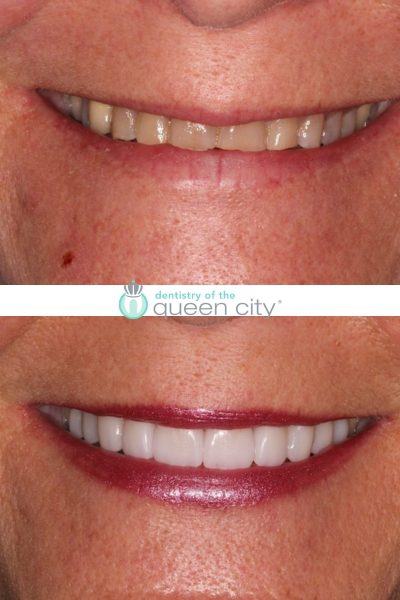 Before and after dental services at Coastal Cosmetic & Implant Dentistry