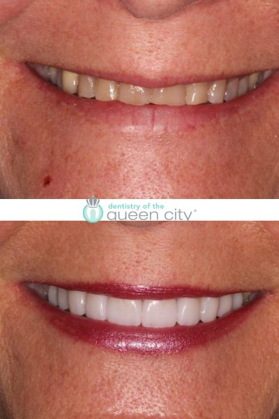 Before and after dental services at Dentistry of the Queen City