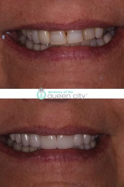 Before and after dental services at Coastal Cosmetic & Implant Dentistry