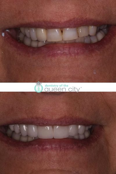 Before and after dental services at Dentistry of the Queen City