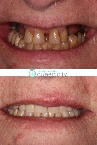 Before and after dental services at Coastal Cosmetic & Implant Dentistry