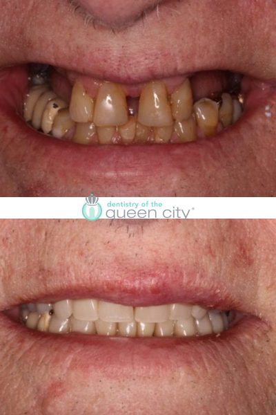 Before and after dental services at Dentistry of the Queen City