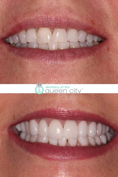 Before and after dental services at Dentistry of the Queen City